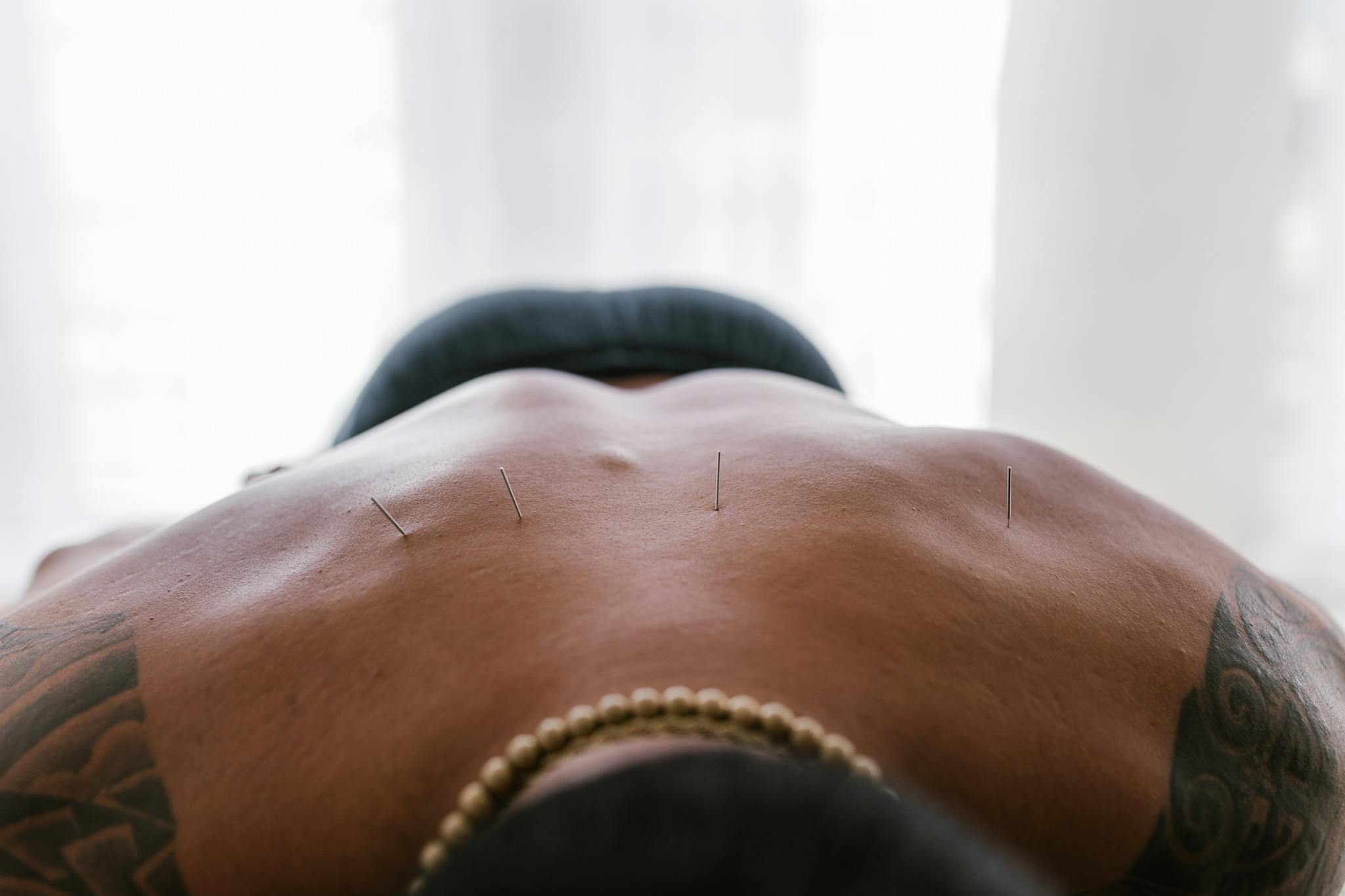 Close-up image of acupuncture needles applied to a person's back during treatment.